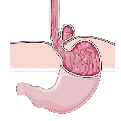 Anti_Reflux & Hiatus Hernia Surgery